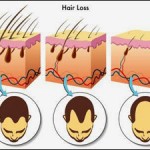 Hair loss graphic