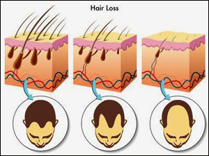 Hair loss graphic