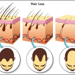 hair loss diagram