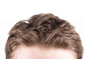 different types of hair loss in new bedford
