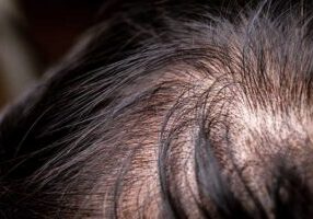hair loss treatment for men in New Bedford