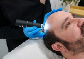 customized treatment for male pattern baldness