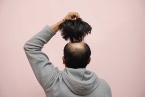 cause of hair loss in men