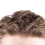 different types of hair loss in new bedford
