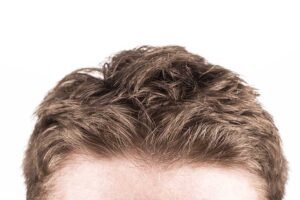 different types of hair loss in new bedford