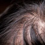 hair loss treatment for men in New Bedford
