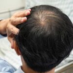 laser hair therapy for men in Massachusetts