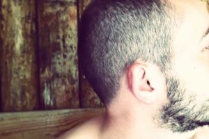 male pattern baldness signs