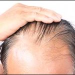 male pattern baldness solutions