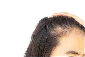Hair Loss Solutions for Women