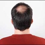 male pattern baldness boston area