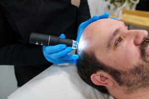customized treatment for male pattern baldness